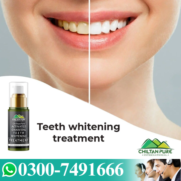 Activated Charcoal Teeth Whitening Treatment